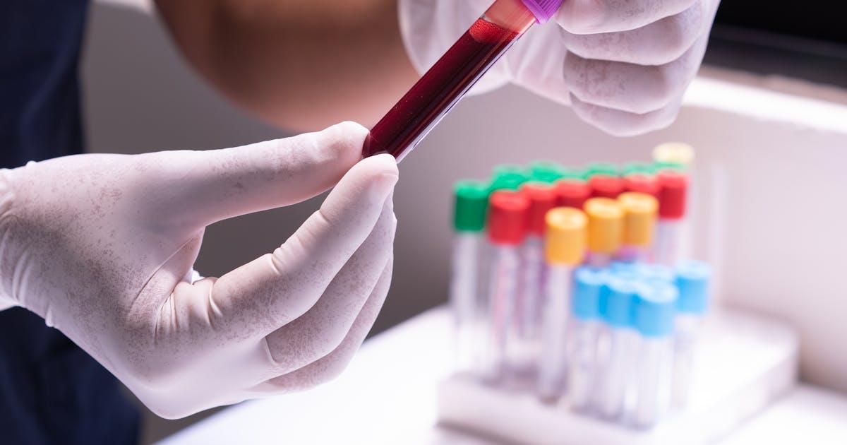Liquid Biopsy Blood Tests Revolutionize Early Cancer Detection Years Before Symptoms