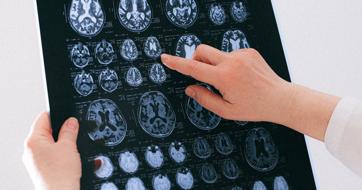 Revolutionary CGRP Inhibitor Medications Transform Migraine Prevention